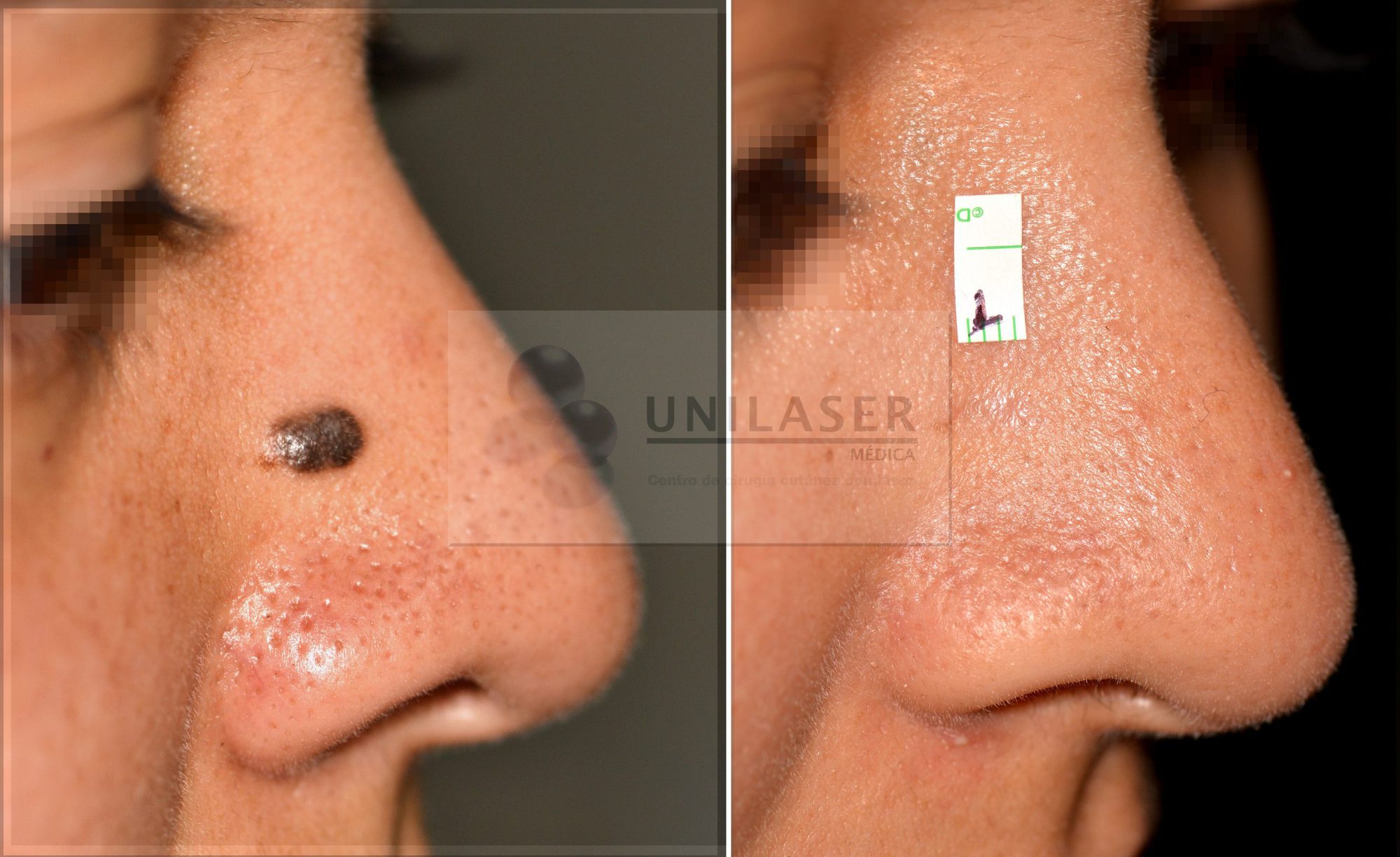 Nevus de Mesicher del dorso nasal