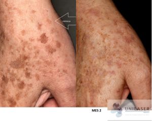 Comparison of the back of a hand with skin spots and a marked wart, with follow-up at two months of treatment.