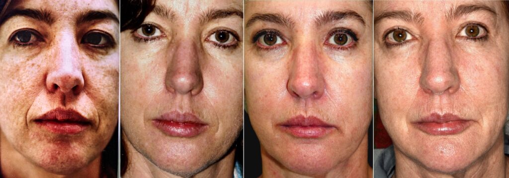 seguimiento sesiones laser en intervalos de 7 años