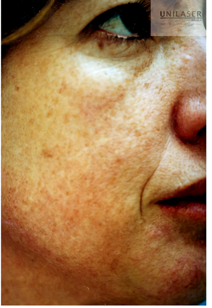 diffuse and light lentigines on light skin