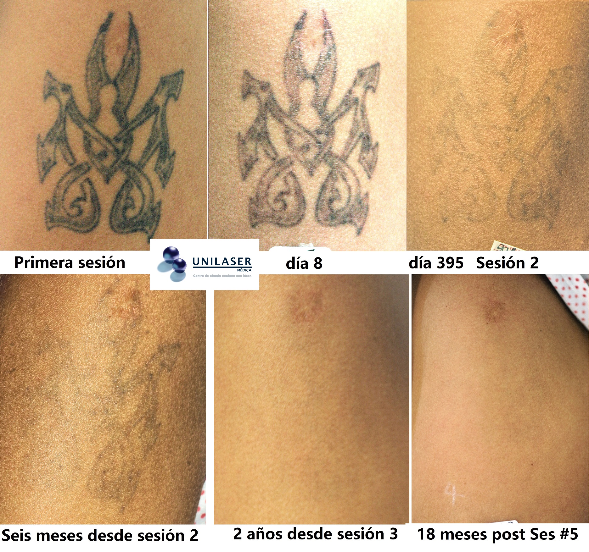 jalea querido crecimiento Remoción de Tatuajes con Láser - UNILASER MÉDICA