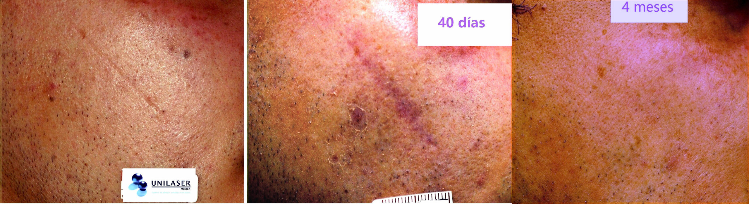 Cicatriz atrófica tratada con dermoabrasión más láser Fraxel Cicatriz atrófica de la cara tratada con dermoabrasión láser