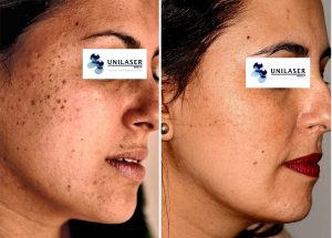 queratosis seborreicas tratadas con láser