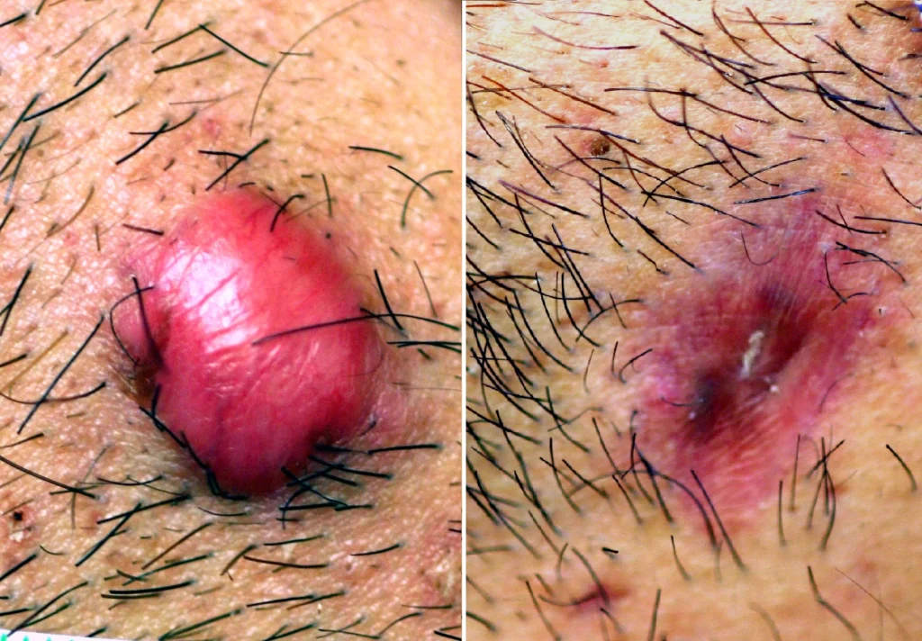 Tratamiento de un Queloide con infiltraciones