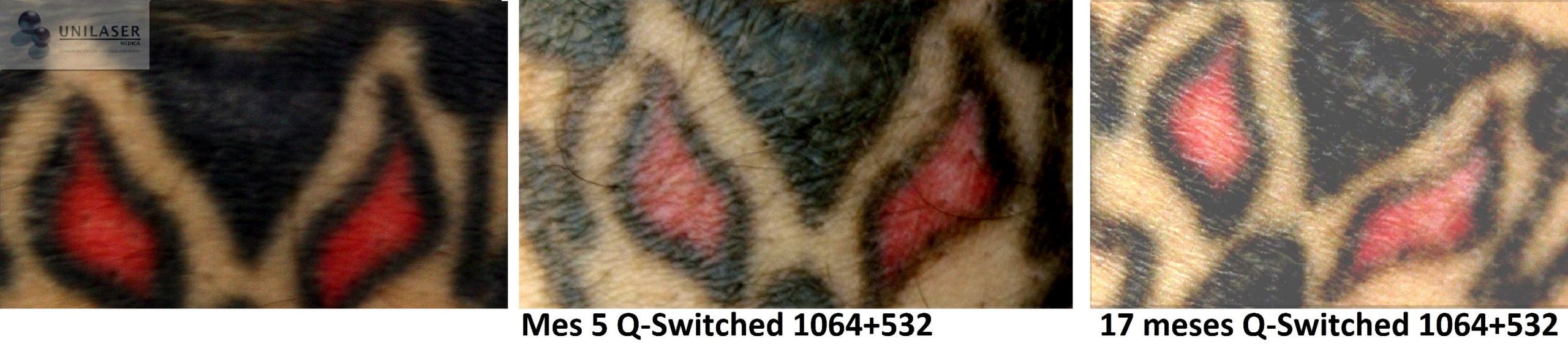 seguimiento 1 sola sesión Q-Switched 17 meses después Seguimiento una sesión láser para tatuajes