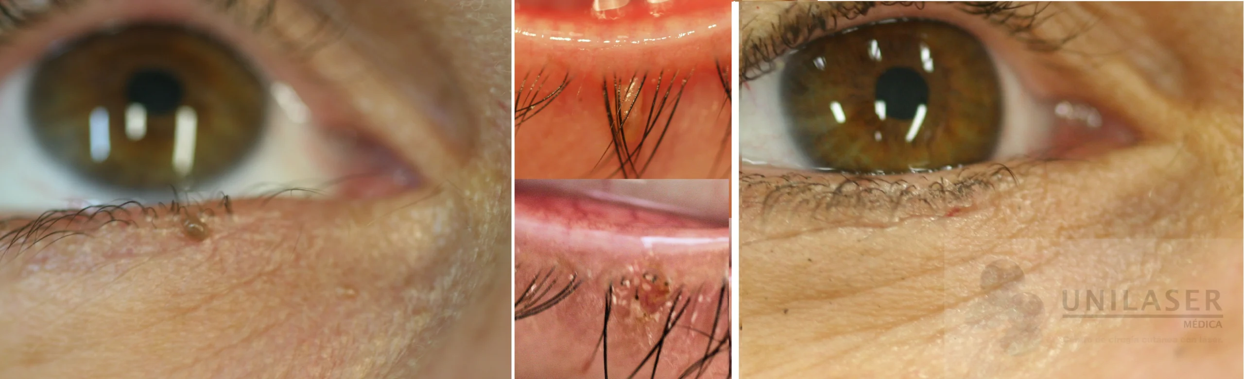 Tratamiento Queratosis Seborréica