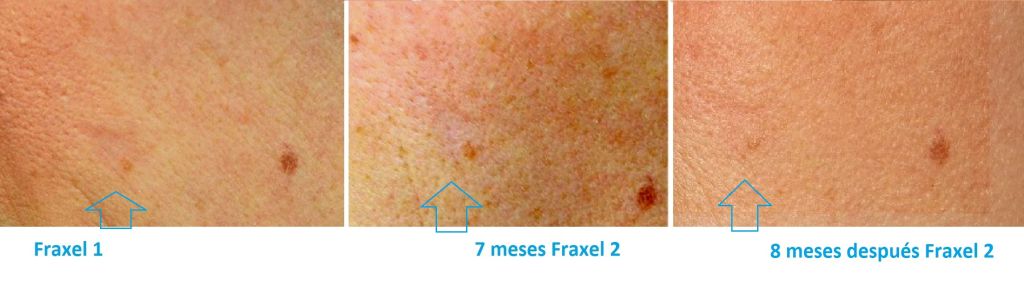 Efecto del Fraxel en cicatrices excavadas