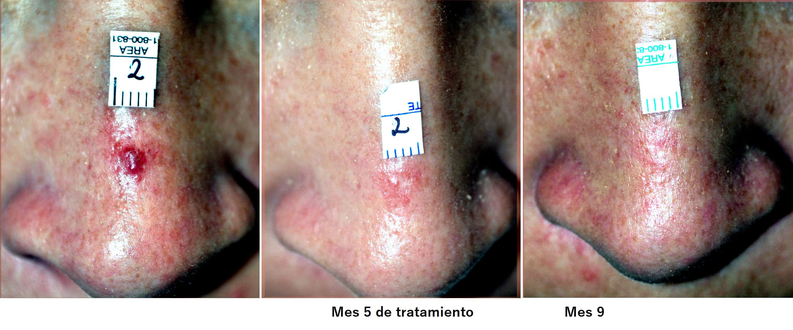 20150914 (41) – copia Spider nevus
