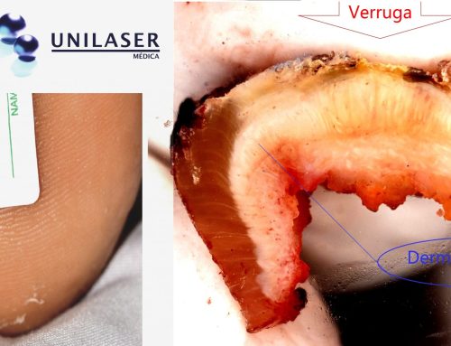 The warts plantar, further deep of it that They seem