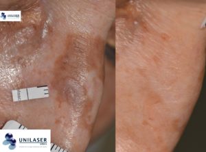 Los léntigos son más que manchas