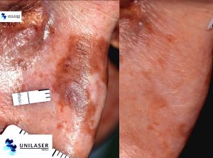 Complex lentigo of the nasal dorsum
