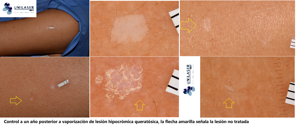 Erbio-YAG and hipomelanosis Guttata 