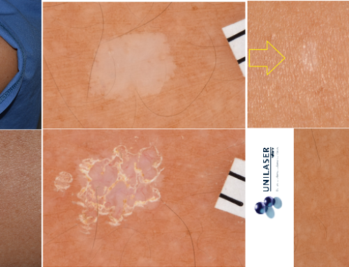 Hypomelanosis guttata evolution to a year of vaporization with laser