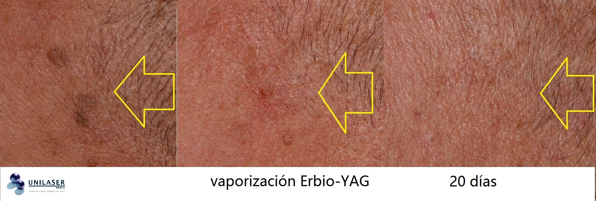 Efecto del láser