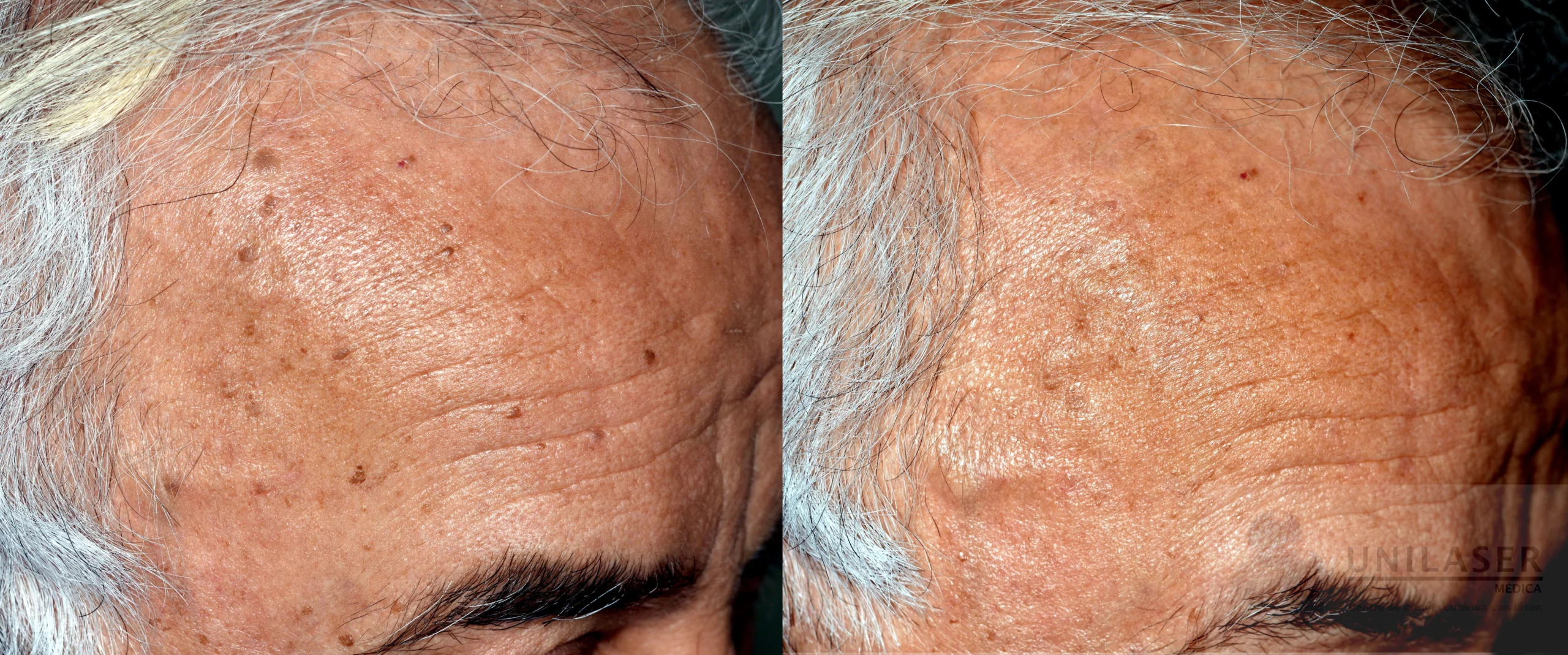 Eliminación de queratosis seborreíca