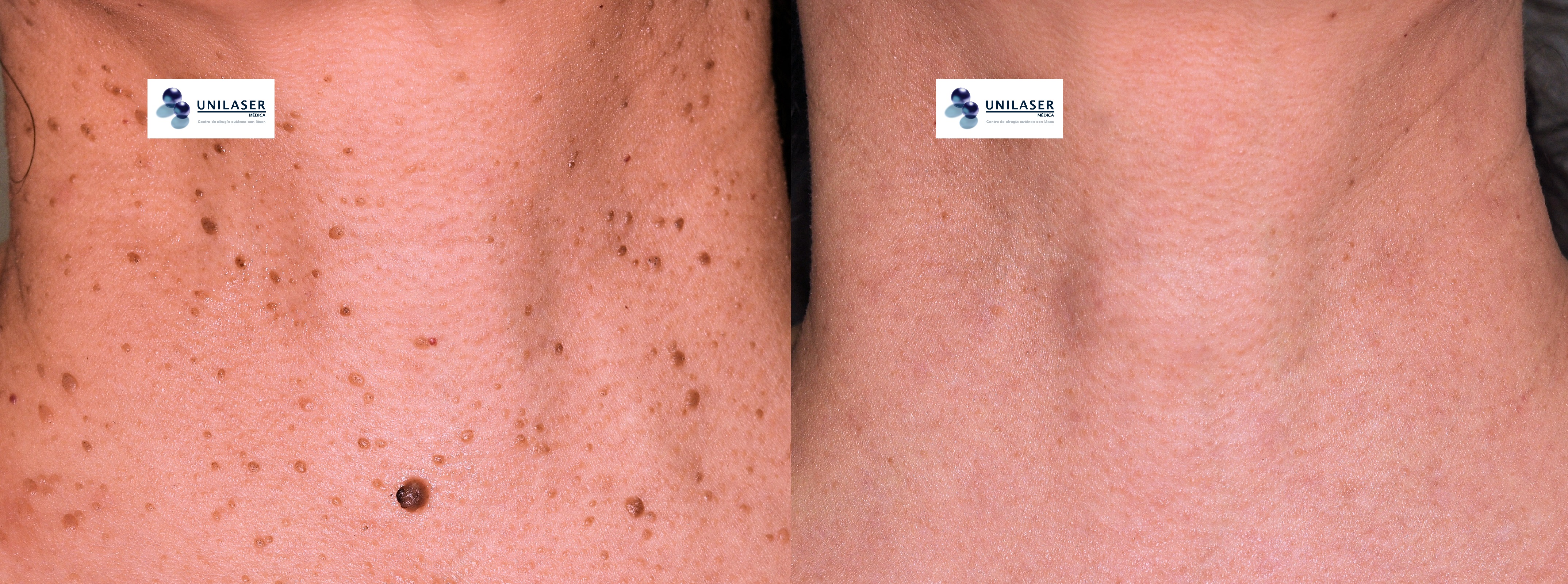 Un sitio de frecuente de presentación es el cuello, en donde, suele presentarse con otra variedad de lesiones como los fibromas y pequeños hemangiomas de diversos tamaños