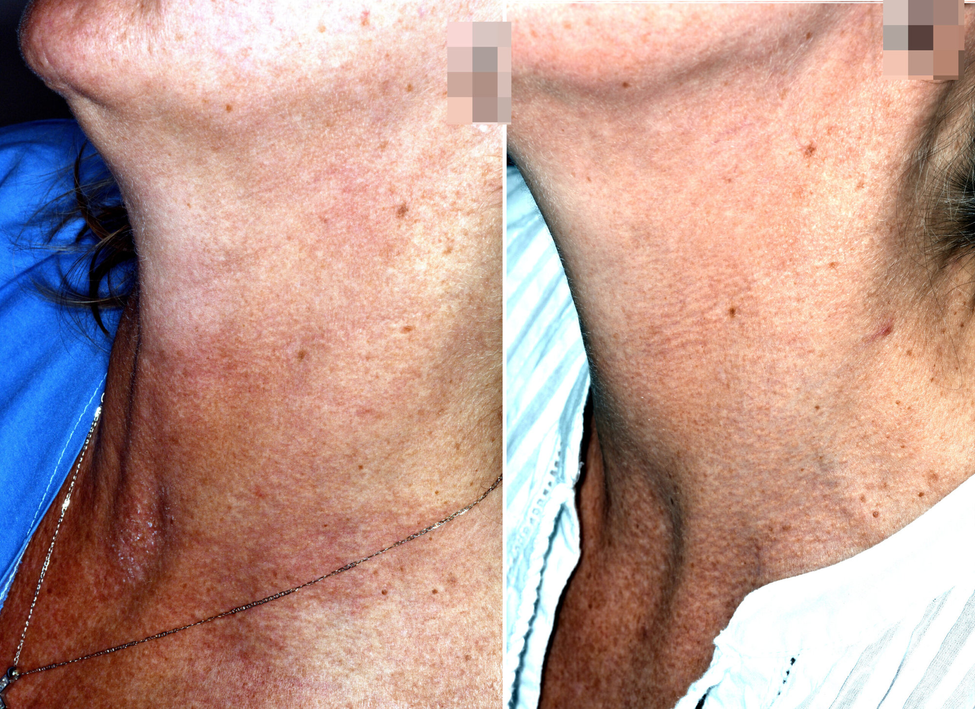 Poiquilodermia tratamiento con láser Fraxel Fotodaño tratado con láser