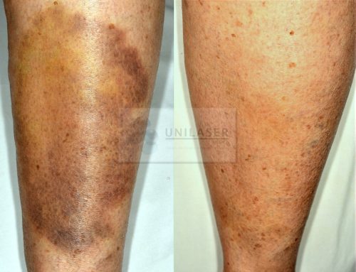 Lamp Aktilite for eliminate bruises