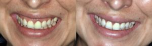 Botox para sonrisa gingival