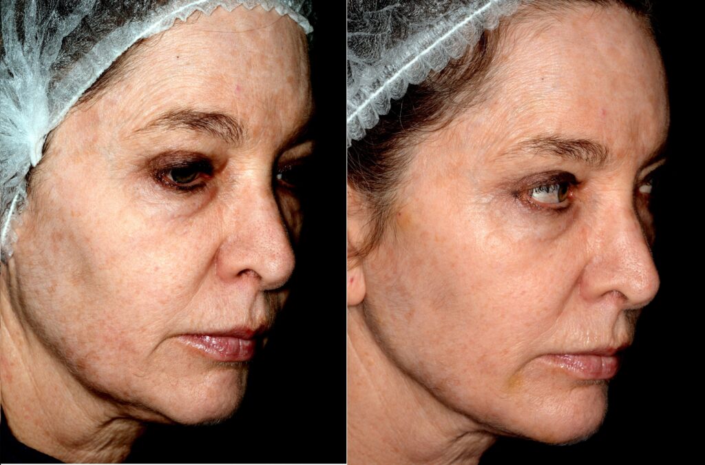 Rejuvenecimiento facial con ácido hialurónico