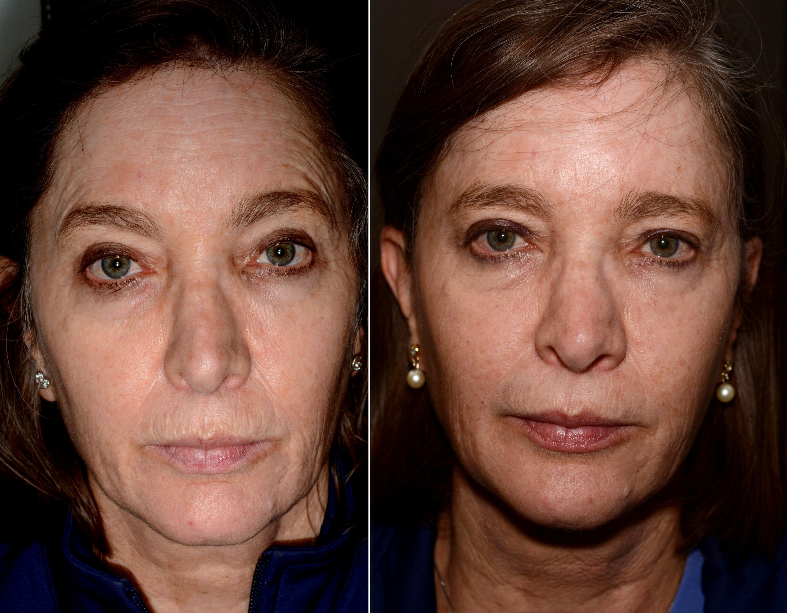 Efecto del Botox Efecto del botox