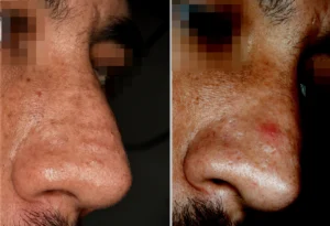 Papular scars on the nasal dorsum