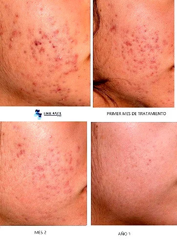 Acné inflamatorio. Evolución durante el primer año de tratamiento, con disminución progresiva de las lesiones activas y de las marcas recientes.