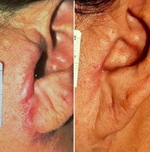 Infiltraciones en cicatriz hipertrófica