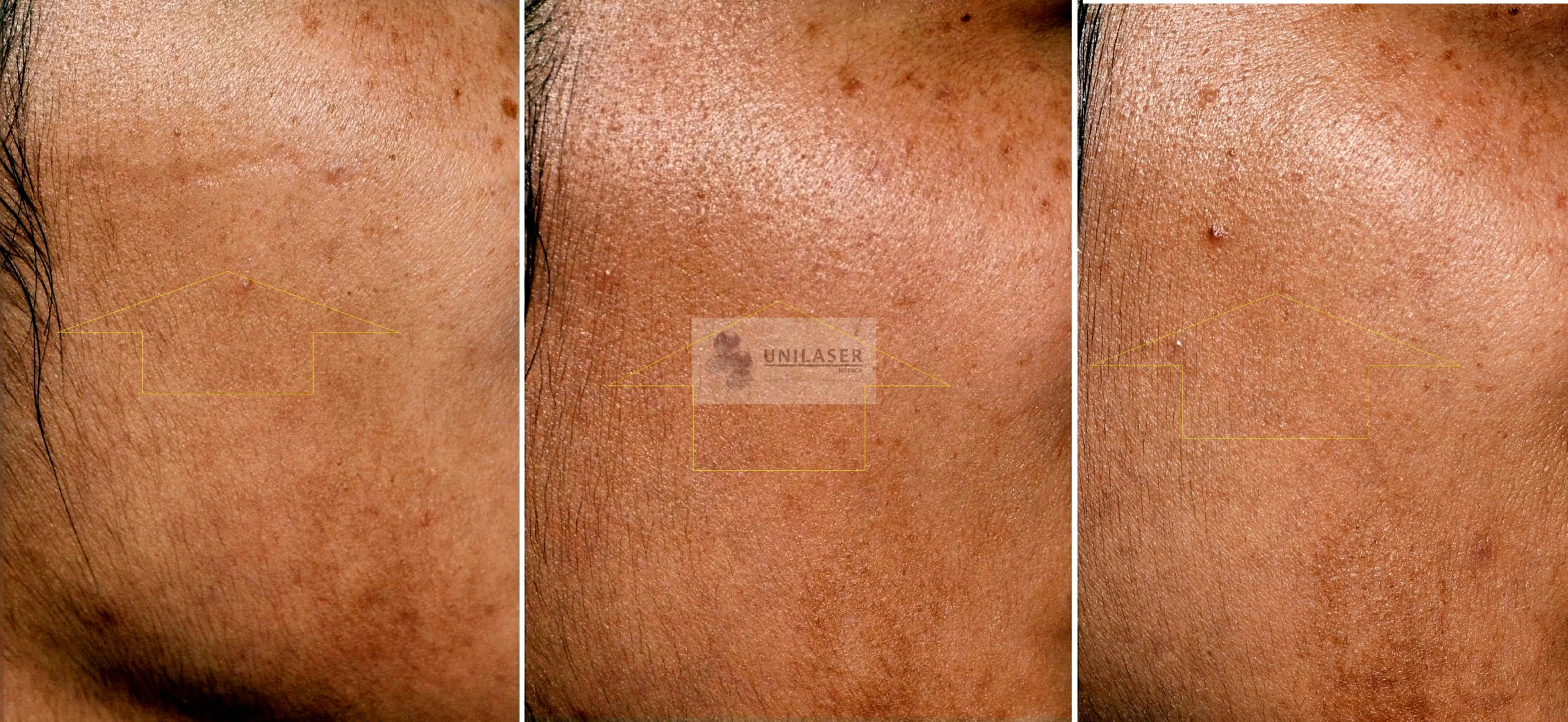 Old atrophic linear scar
