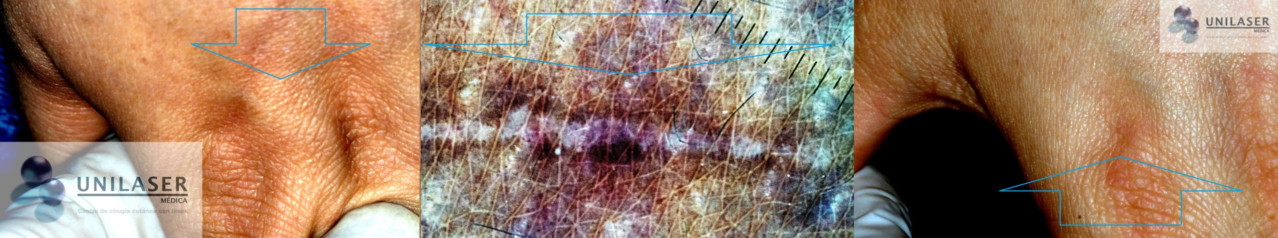 Laser scar removal