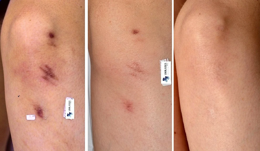 Sequence of treatment for recent scar