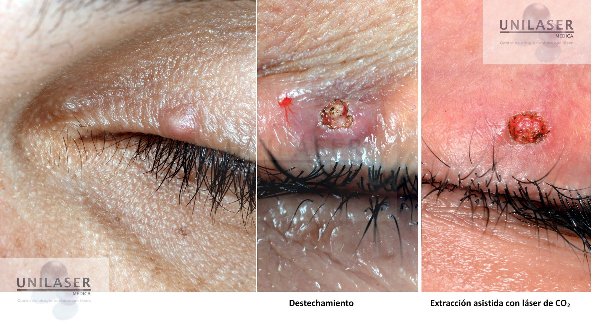 Extracción quiste epidermoide palpebral Extracción quiste epidermoide palpebral