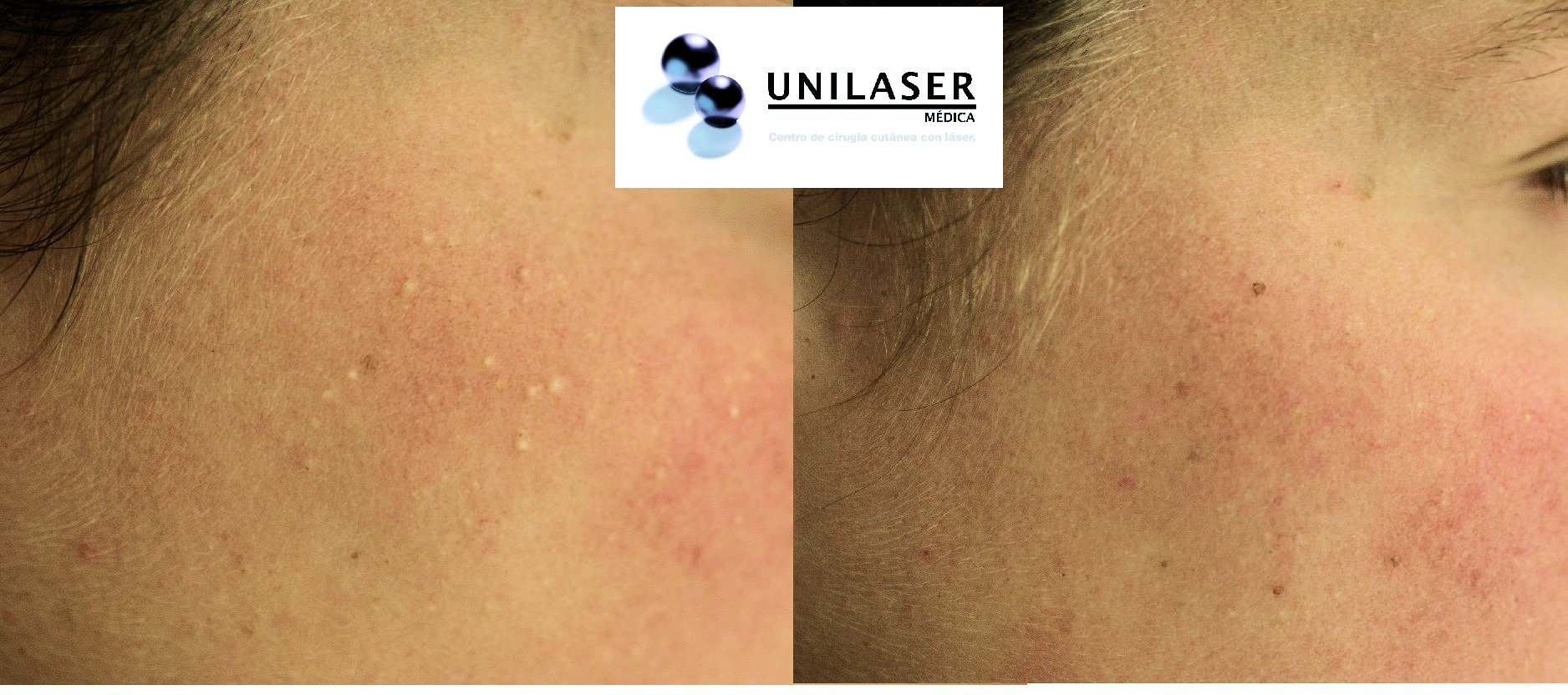 Destechamiento, vaporización de microcapsulas asistida con láser y microscopio Destechamiento, vaporización de microcapsulas asistida con láser y microscopio