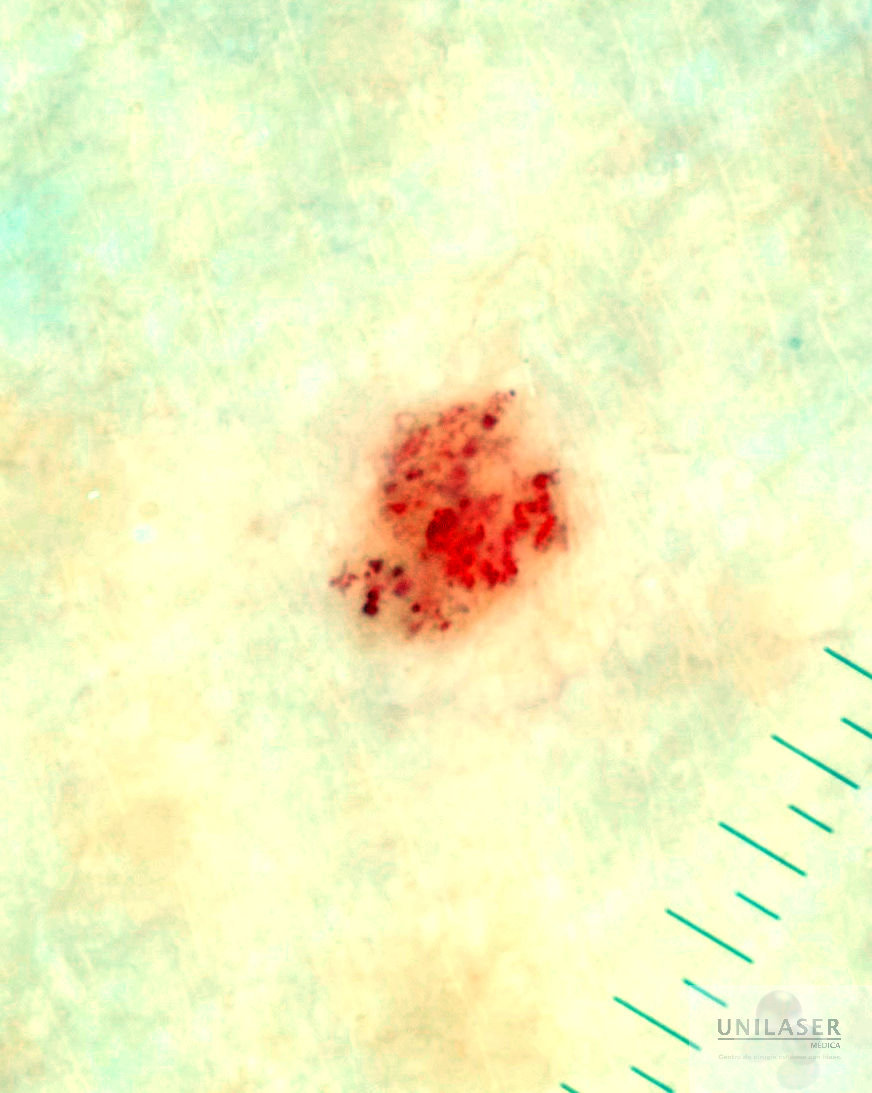 cherry angioma