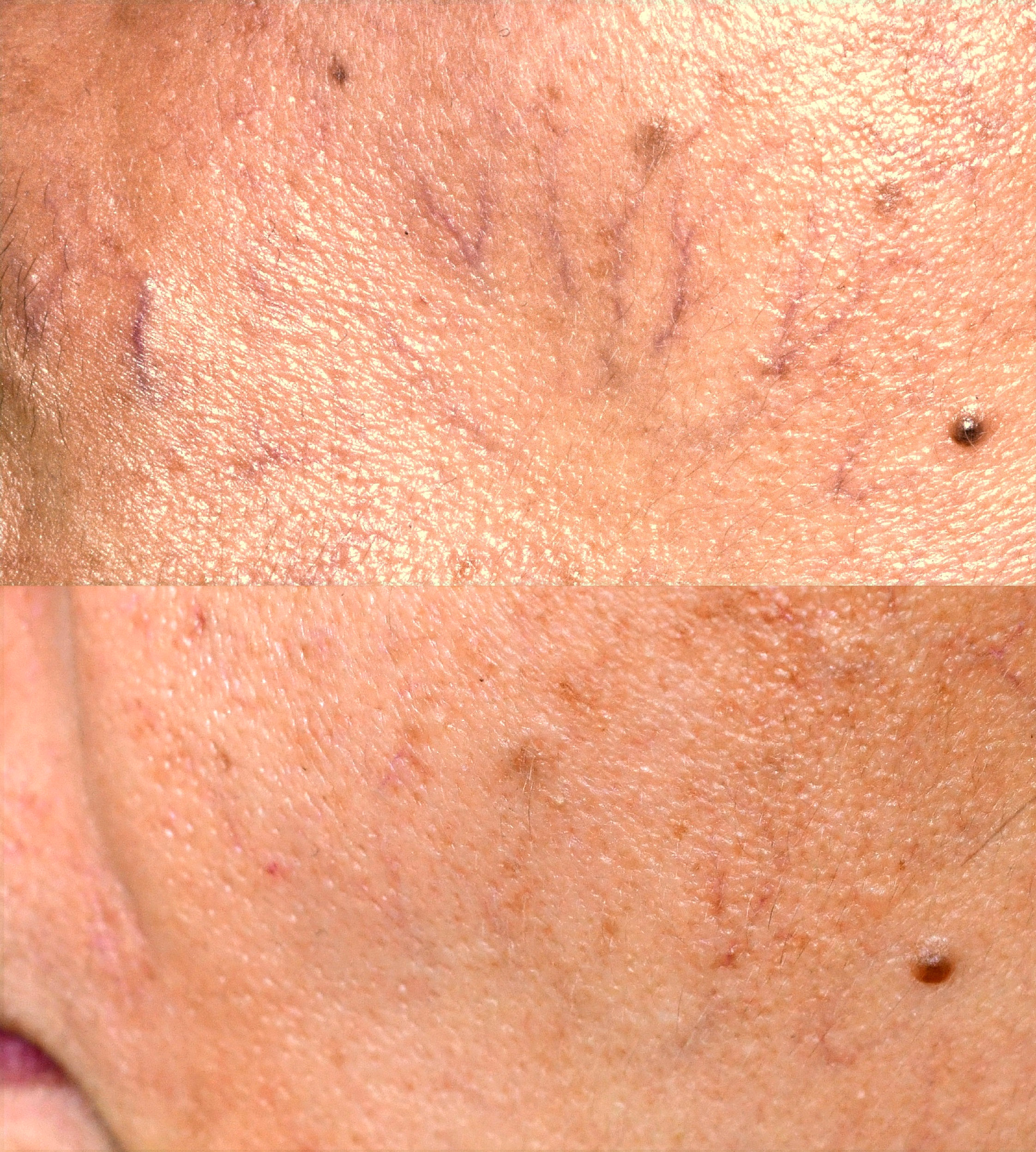 Primelase for vascular lesions of the face