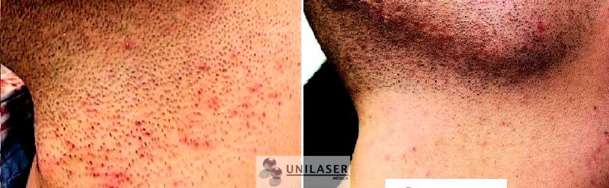 Pseudofoliculitis de la barba · antes y después de reducir la población de pelo.