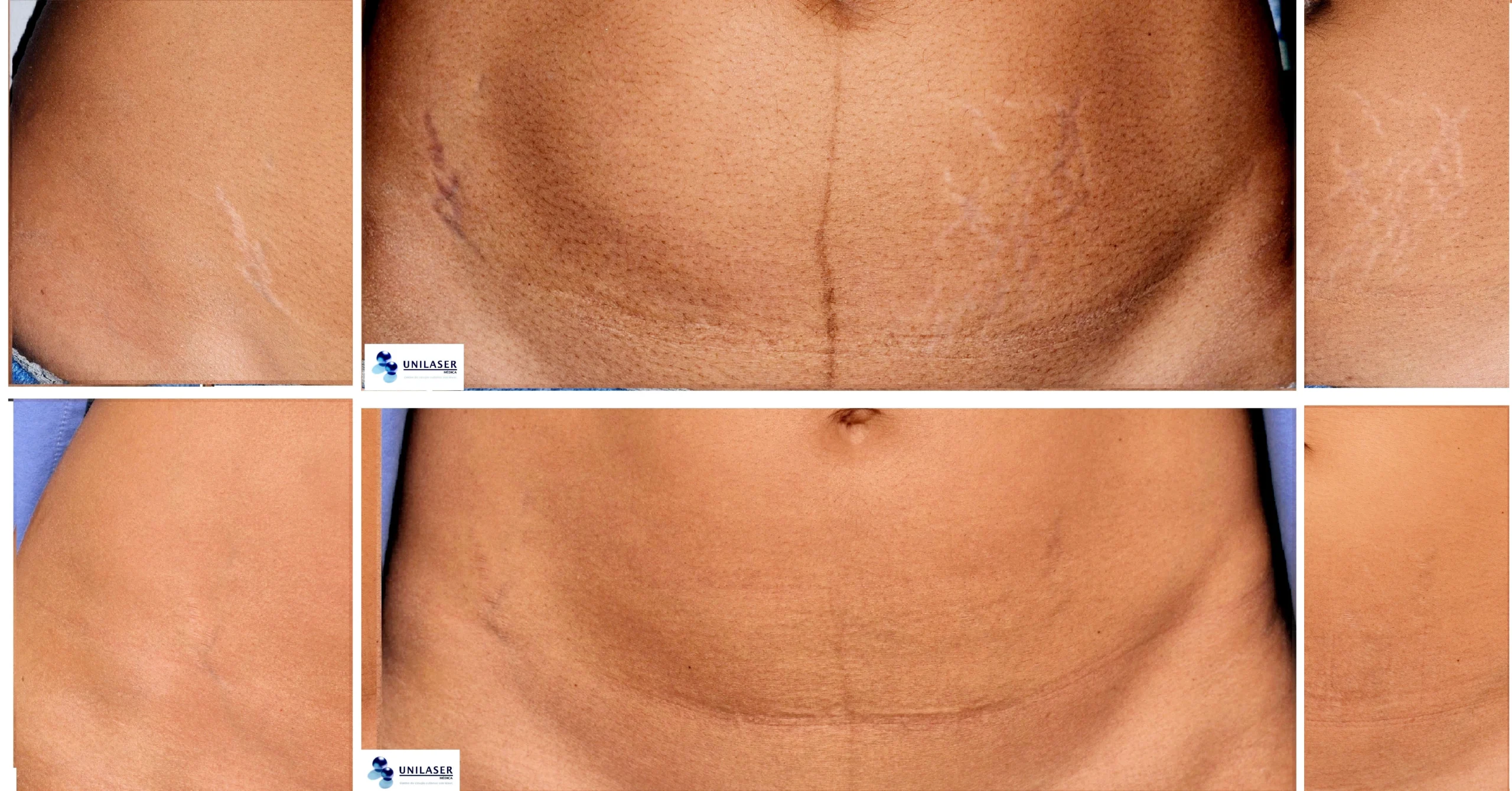 Resultado a un año y medio posterior al láser en estrías abdominales Láser en estrías abdominales