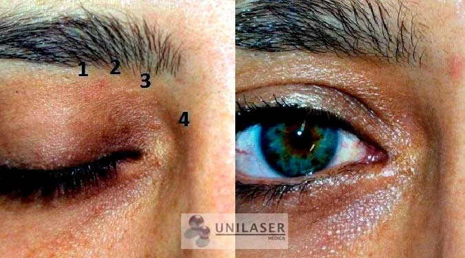 Siringomas perioculares focales antes y después del tratamiento.