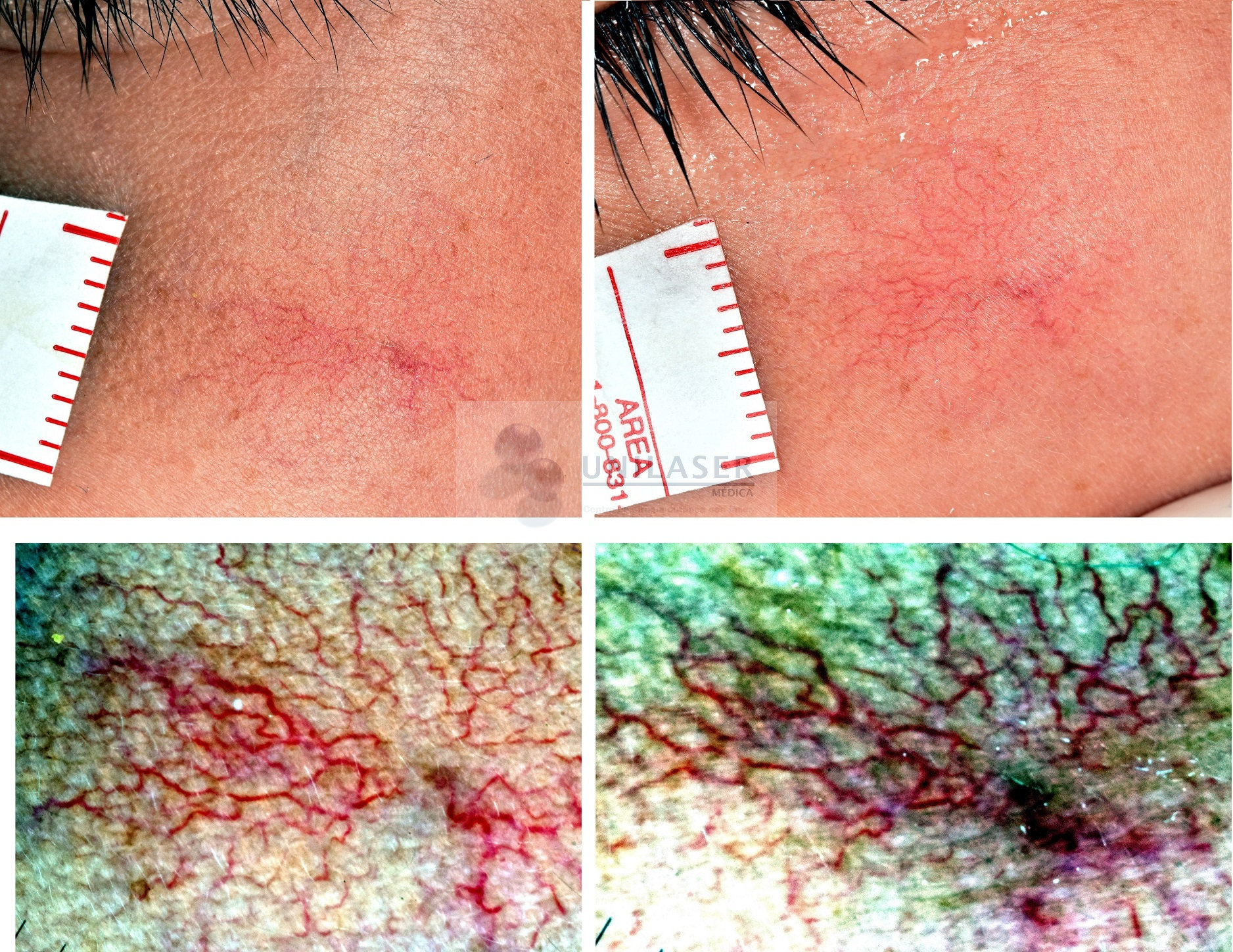 second vascular laser spider nevus session