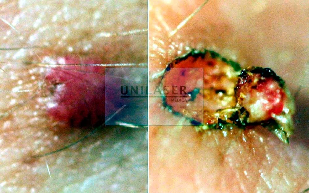 Afeitado tangencial: la resección permite verificar el plano superficial de la lesión.