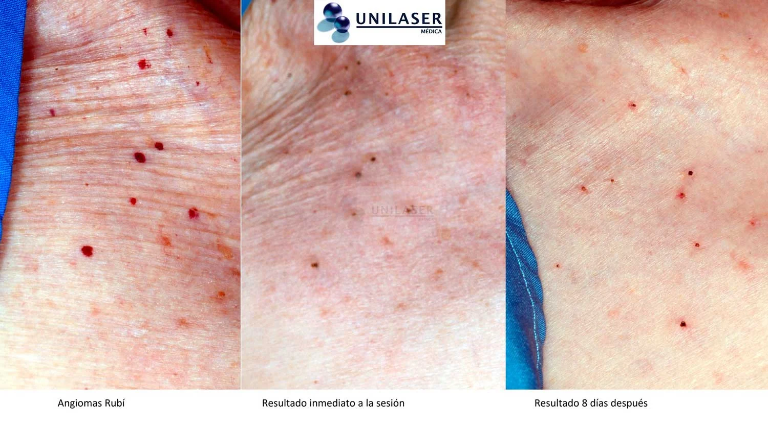 Angiomas rubí múltiples: aspecto inicial, resultado inmediato y control a los 8 días.