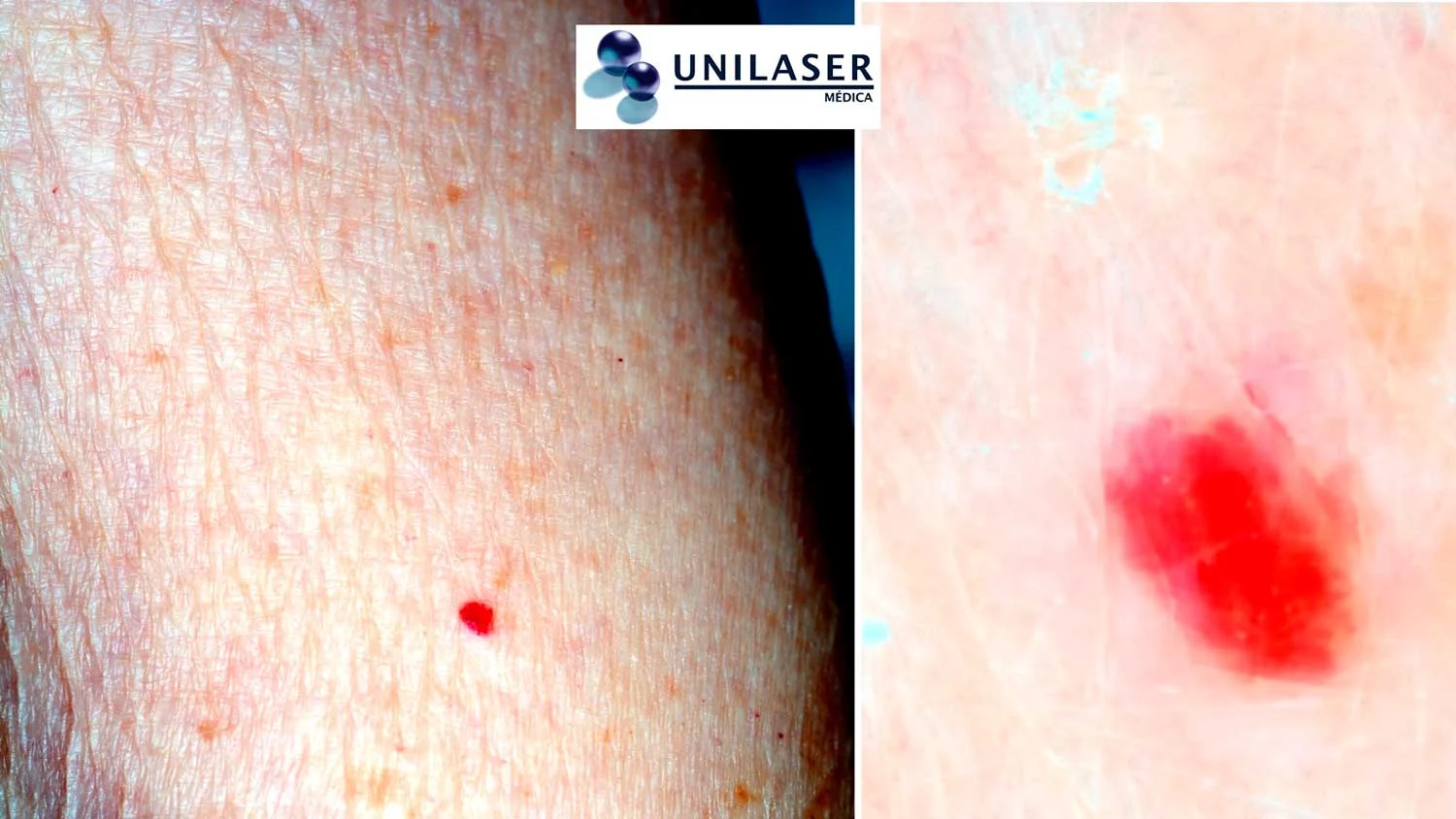 Angioma rubí: aspecto clínico y estructura al aumento.