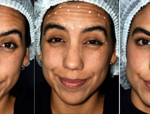 Botox