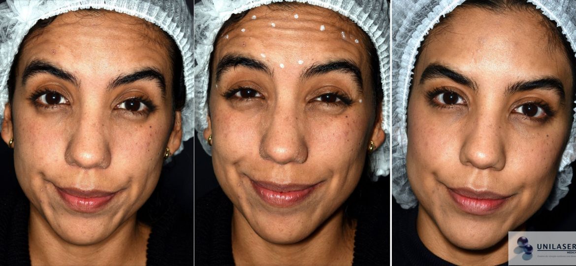 Atenuación de arrugas de la frente con Botox