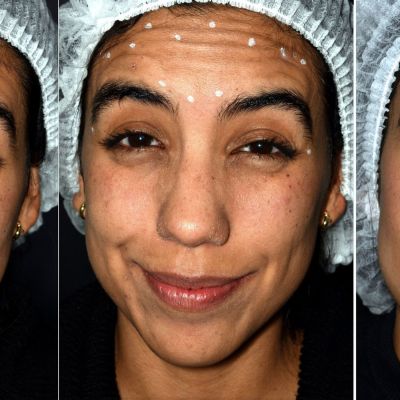 Atenuación de arrugas de la frente con Botox