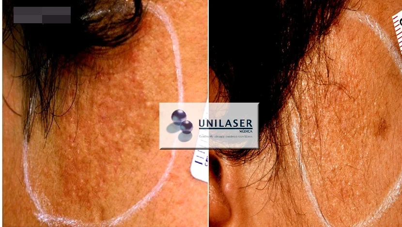 Failed and successful Fraxel laser session