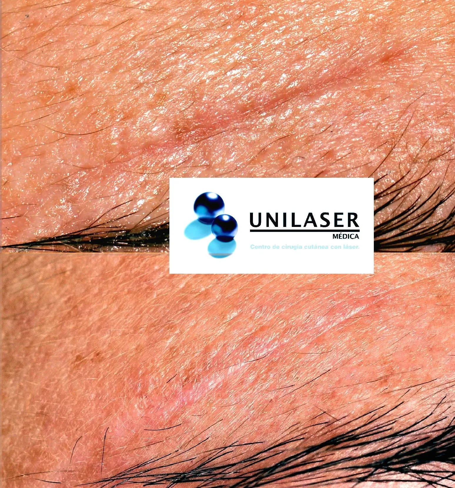 Immature linear scar treated with Fraxel laser