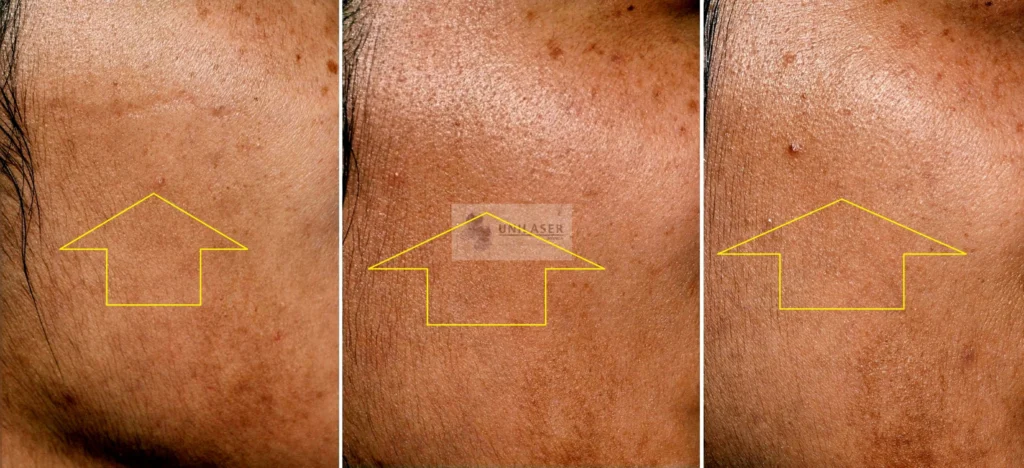 cicatriz linear atrófica antígua tratada con Fraxel Cicatriz facial linear superficial