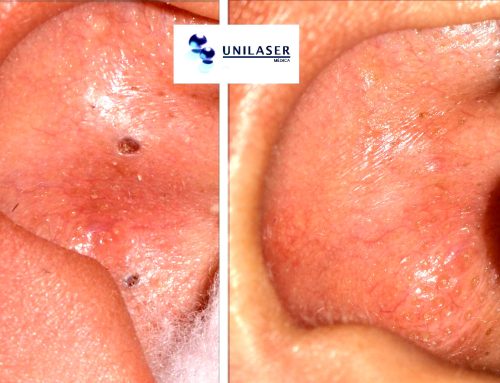 He treatment of the acne with laser