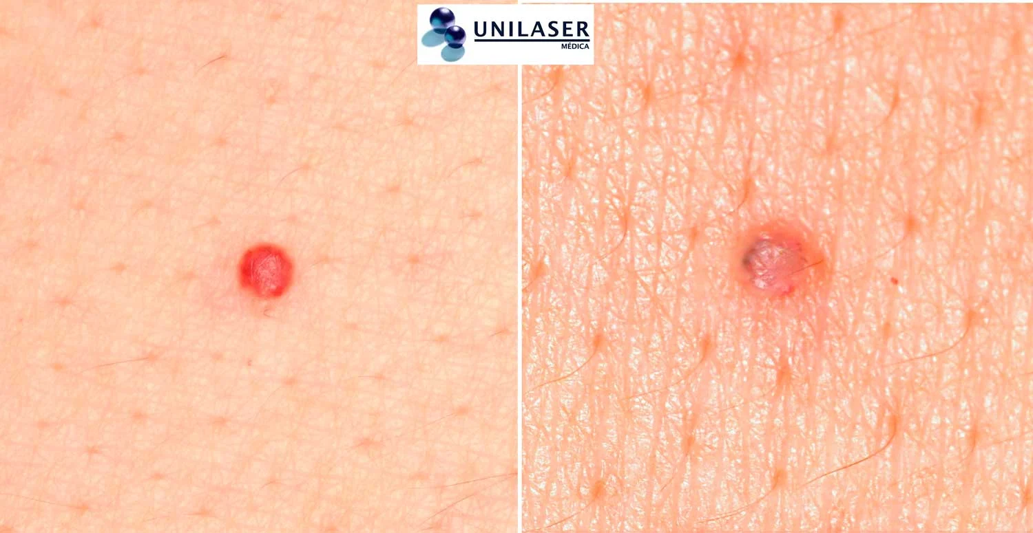 Cambio del componente vascular después del impacto del láser.